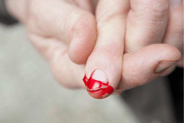 bleeding finger